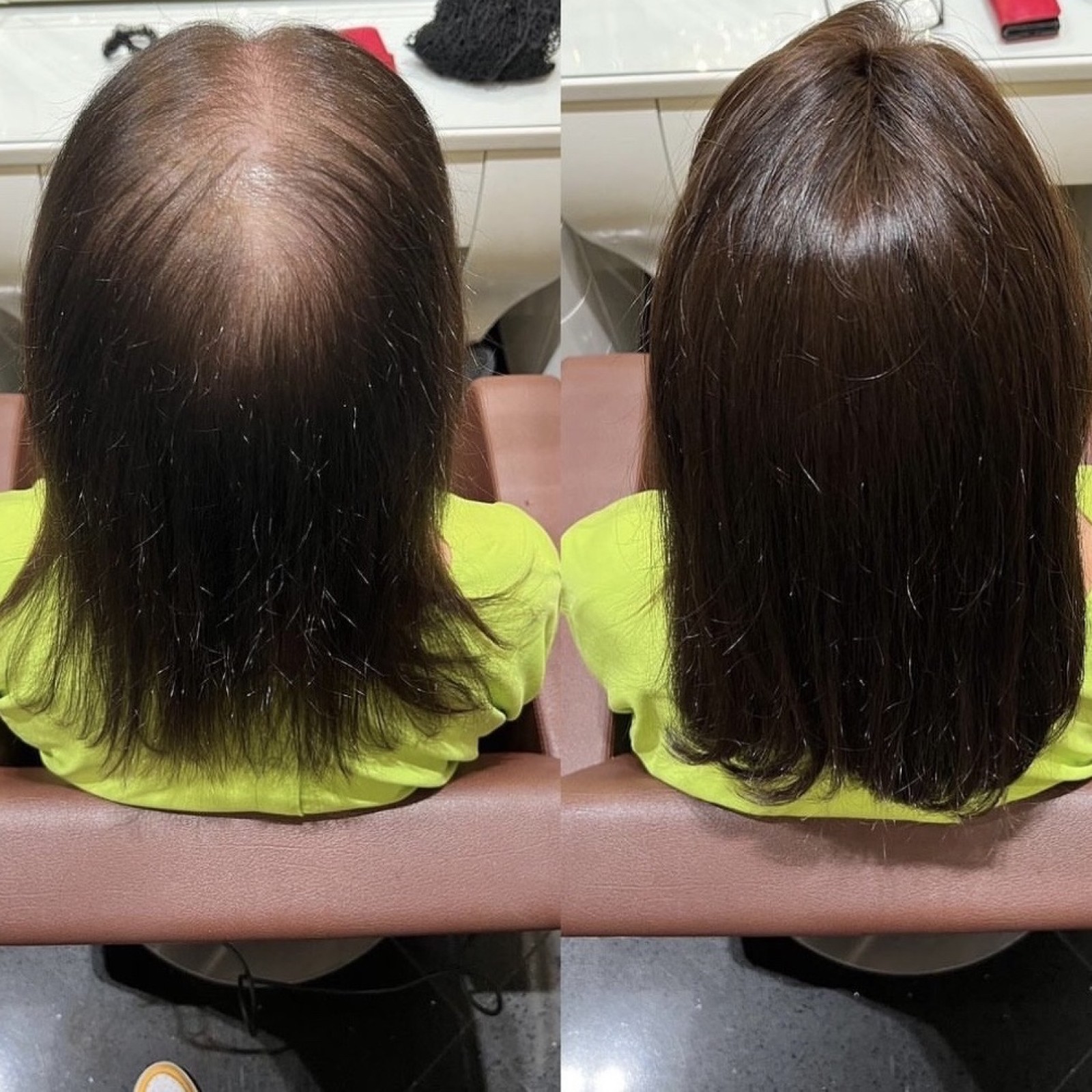  Complément capillaire pour personnes, ayant subi une grosse chute de cheveux pour Homme ou pour Femme, pouvant être remboursé par la sécurité sociale 
à la ciotat et ses environs 